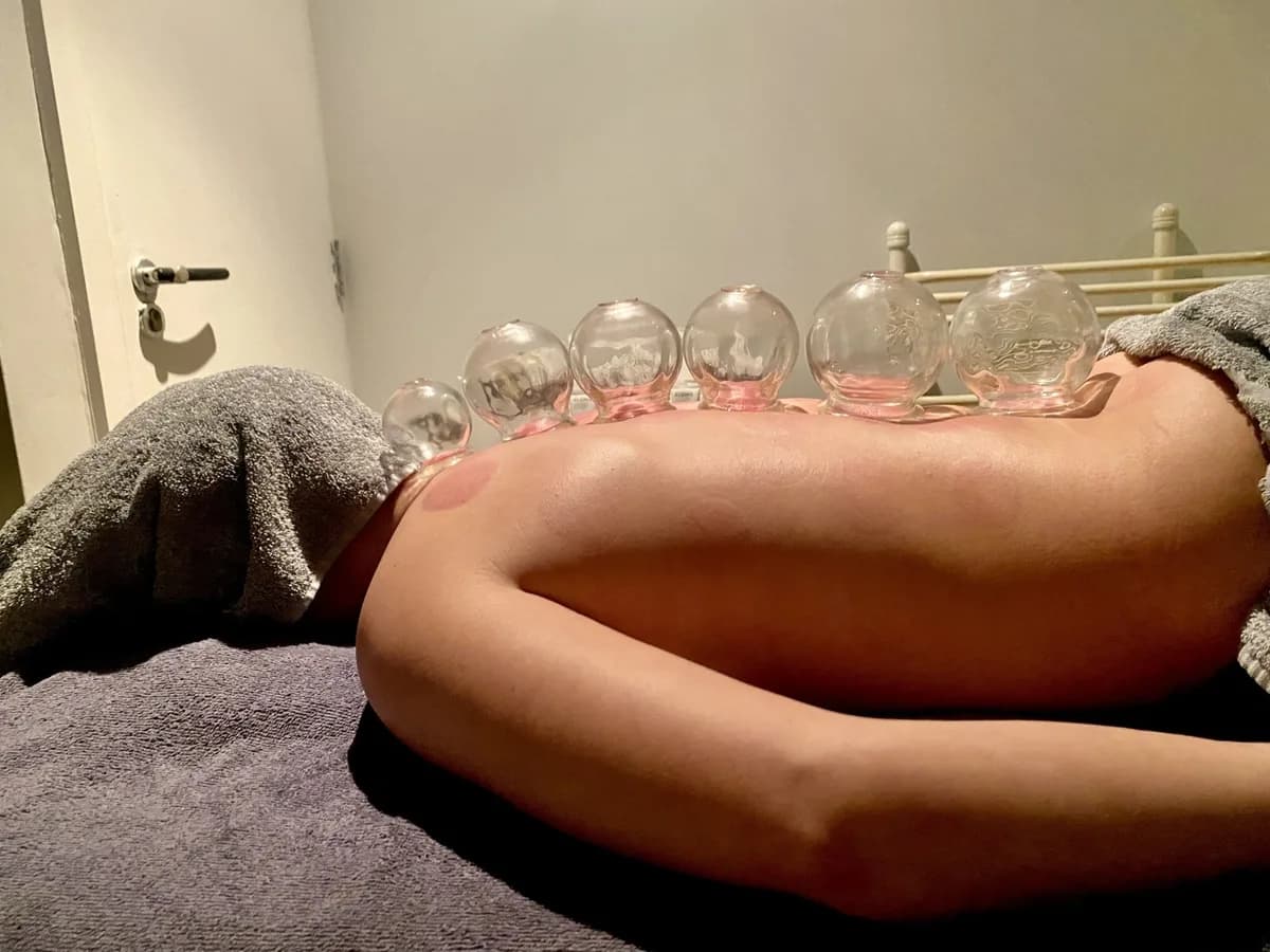 Cupping Therapy