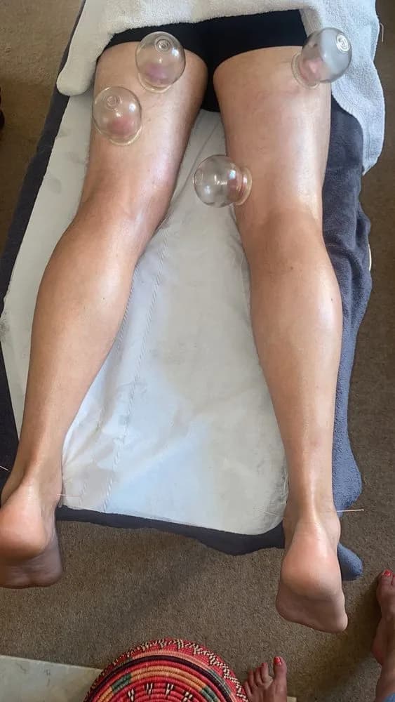 Cupping Therapy on Legs